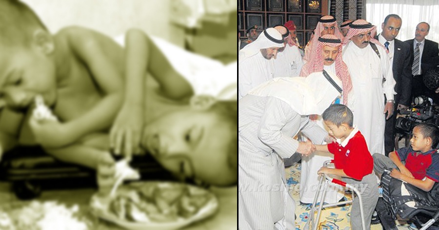 Kos Pembedahan RM1.3 Juta. Ini Kisah Kembar Ahmad Muhamad Dibantu Putera Arab Saudi